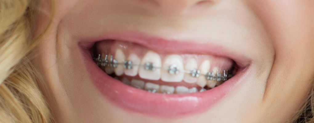 Orthodontie - Centre dentaire Ravis
